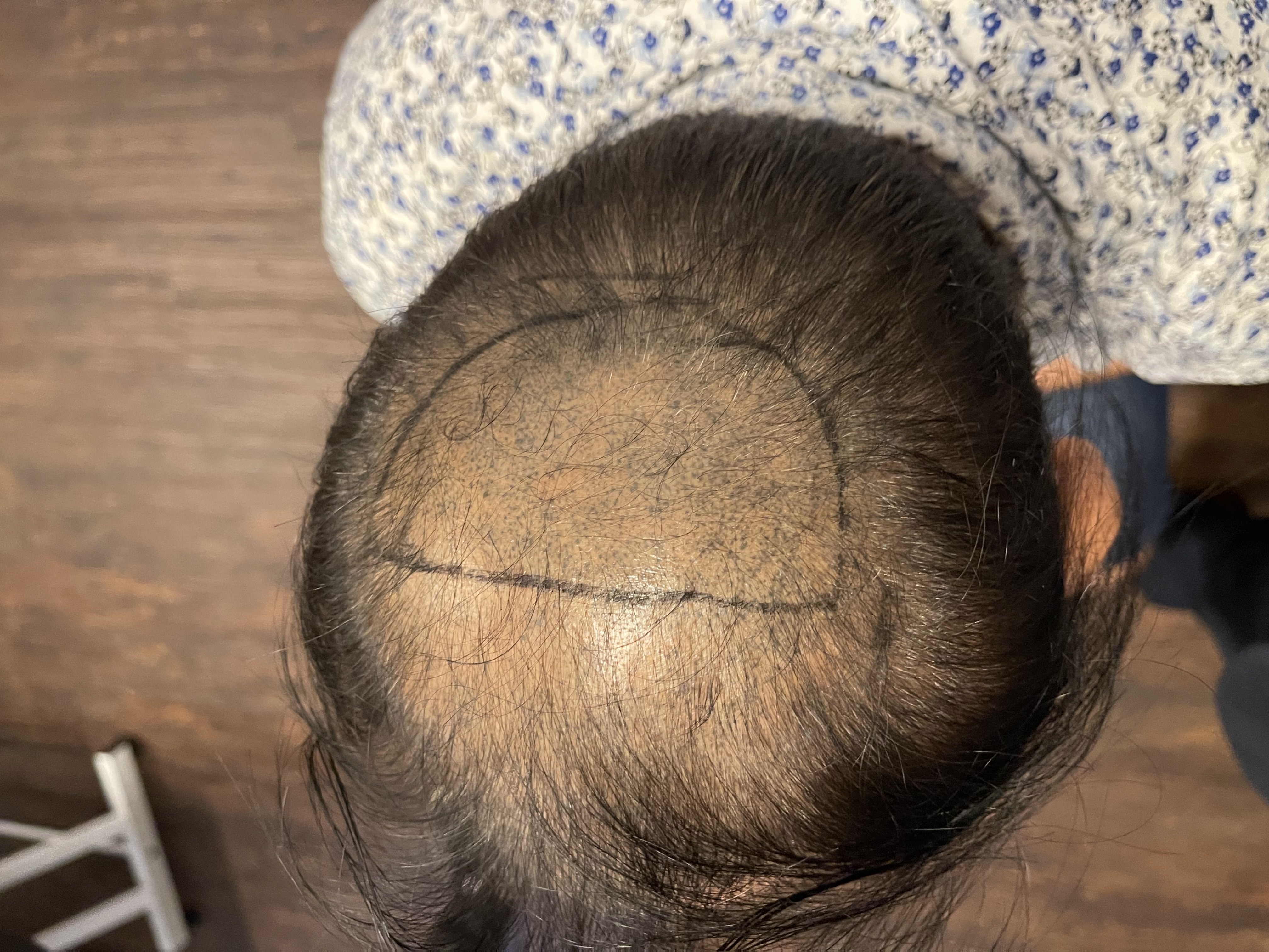 Nishant hair transplant result photo 3